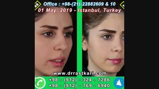 نموذج جراحه الانف فی اسطنبول