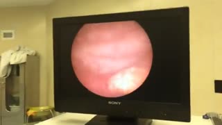 دفع سنگ حالب به روش سنگ شکنی درون اندامی