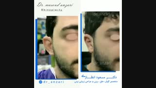 فیلم عمل زیبایی لاله گوش