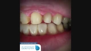 فیلم انجام 20 واحد لمینیت سرامیکی