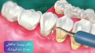انیمیشن جرم گیری دندان