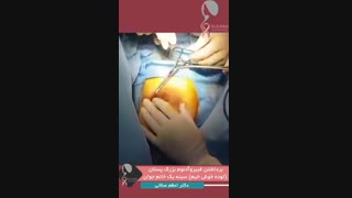 خانمی با تومور بدخیم بالای هاله سینه