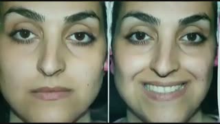 عمل بینی استخوانی | دکتر امید ابراهیمی پروتز سینه