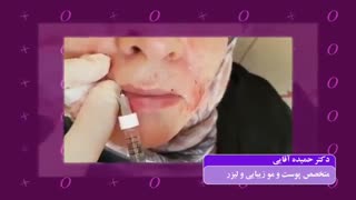 فیلم تزریق ژل لب برداشتن زگیل