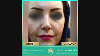 جراحی بینی