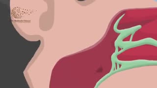 رینیت آلرژیک