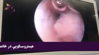 عمل هیستروسکوپی پولیپ رحم