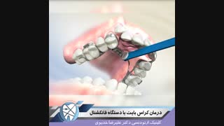 درمان کراس بایت بادستگاه فانکشنال.متخصص ارتودنسی.دکتر علیرضا خدیوی