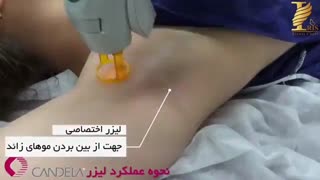 عملکرد لیزر موهای زائد پروتز سینه