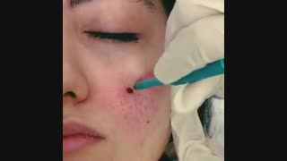 رفع جای جوش با پانچ