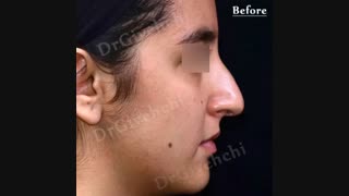 جراحی بینی توسط دکتر گیوه چی