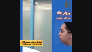 پروتز چانه و ساکشن غبغب