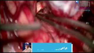 فیلم جراحی تومور مغزی پسر ۱۳ ساله