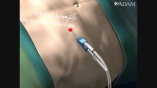 انیمیشن عمل لیپوساکشن