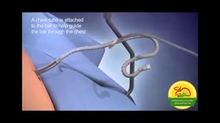 جراحی فرورفتگی قفسه سینه ( قیفی شکل)