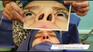 جراحی ترمیمی بینی کج توسط دکتر امید ابراهیمی بهترین جراح بینی