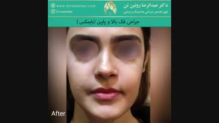 جراحی فک بالا و پائین | فوق تخصص جراحی پلاستیک | دکتر عبدالرضا روئین تن