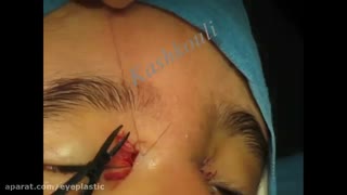فیلم عمل کانتوپلاستی در بلفاروفیموز توسط پروفسور کشکولی