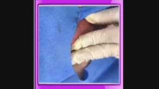 فیلم سابسیژن پلاستیک لثه