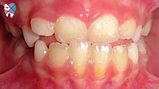 ارتودنسی جبرانی.متخصص ارتودنسی تهران.دکترعلیرضاخدیوی ترمیم ونیر