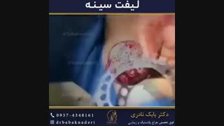 تا به حال فیلم جراحی لیفت سینه دیده بودید؟