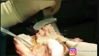 عملیه استبدال مفصل الرکبه