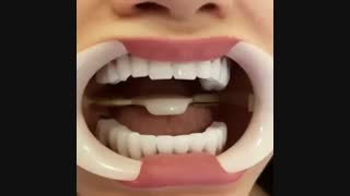 لمینت تمام سرامیکی دندانها
