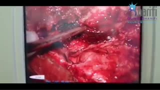 فیلم جراحی تومور مننژیوم چشم چپ
