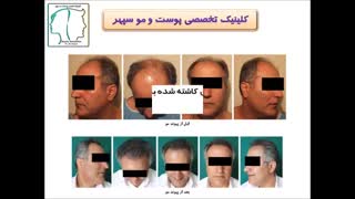 ریزش مو بعد از کاشت مو