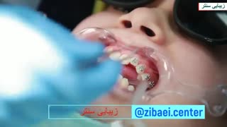 ارتودنسی دندان یا سیم کشی دندان - اصلاح فرم دندان