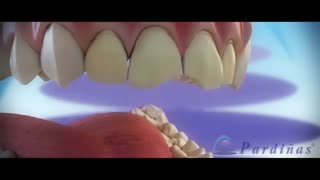 لمینت تمام سرامیکی دندان