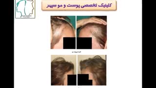 کاشت مو در بانوان