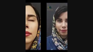 دو ماه پس از جراحی زیبایی بینی