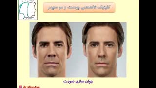 تزریق فیلر (ژل)