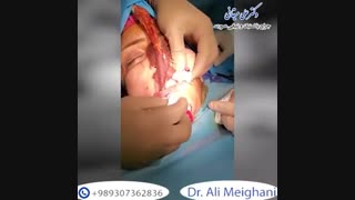 فیلم تخلیه ژل
