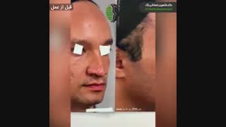 جراحی بینی گوشتی با قاعده پهن | دکتر باستانی نژاد جراح بینی