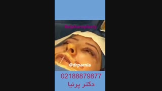 جراحی لیفت صورت کاشت ریش