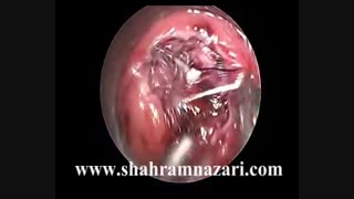 جراحی ترانس آندوسکوپیک پولیپ توبولو ویلوس آدنومای کولون سیگمویید بروشTEO