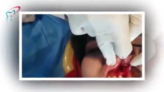 جراحی دندان ۲ همراه با پیوند پودر استخوان