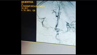 آنژیوگرافی شریان مغزی میانی به کمک استنت و کاتتر