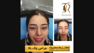 بلفاروپلاستی یا جراحی زیبایی چشم