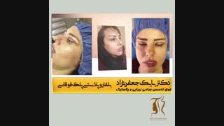 فیلم بلفاروپلاستی پلک بالا