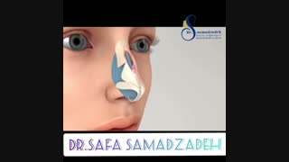 برداشتن قوز بینی در عمل بینی