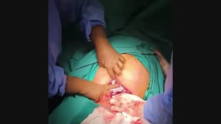 لحظه ای شیرین در زایمان سزارین