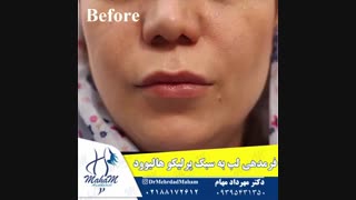 تزریق ژل لب