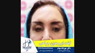 لیفت ابرو