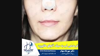 فرم دهی و حجم دهی لب
