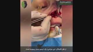 فیلم جراحی بینی ترمیمی بسیار مشکل | دکتر باستانی نژاد | عمل جراحی زیبایی ترمیمی