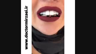 اصلاح طرح لبخند