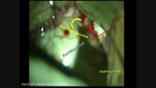فیلم جراحی سوراخ کردن عصب بینایی | پروفسور کشکولی